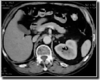 CT scan van het abdomen