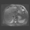 MRI abdomen 1