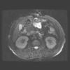 MRI abdomen 3