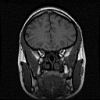 MRI schedel 3