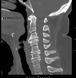 ct_cervicale_zuil_reconstructie