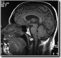 voorbeeld van MRI-beeld